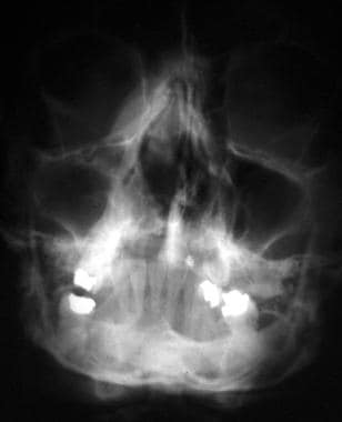 Nasal fractures. Posteroanterior view shows displa