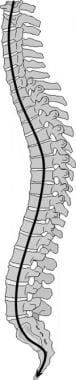 Thoracic spine trauma. Lateral drawing the spine w