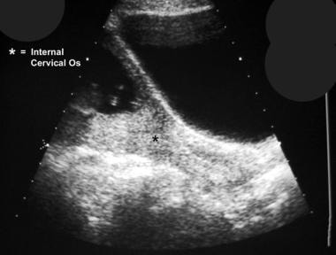 Ultrasonogram shows asymmetric complete placenta p