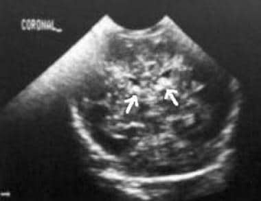 Coronal ultrasonogram of a 1-day-old neonate. The 
