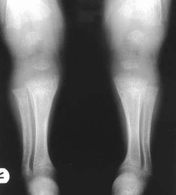 Radiographs of the knee of a 3.6-year-old girl wit
