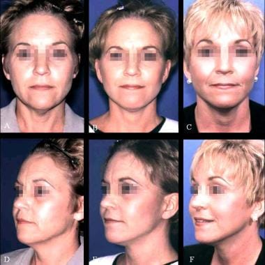 Prerhytidectomy Facial Analysis: Overview, Consultation, Photodocumentation