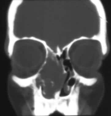 This image demonstrates unilateral nasal polyposis