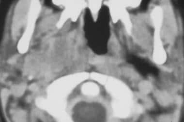 Axial CT scan of right masticator space rhabdomyos