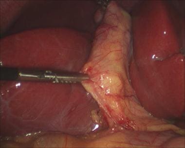 Laparoscopic cholecystectomy. Medial grasper is us