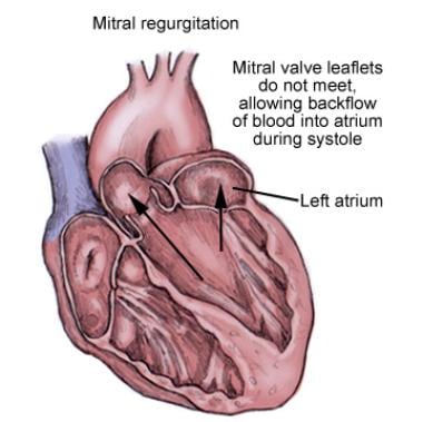 percutaneous mitral valve replacement