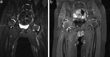 (A) T2-weighted MRI shows high signal in both hips