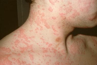 How to treat a rash from a drug reaction