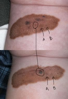 This large congenital nevus developed papular area