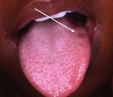 Adriamycin pigmented macule (arrow) on the tongue.