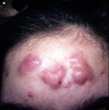 Acne Conglobata Scars