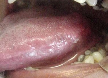 Oral frictional hyperkeratosis of the lateral bord