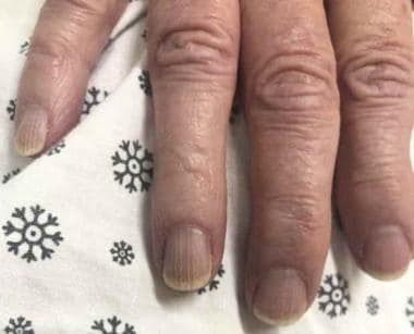 Brittle nail syndrome: A 75-year-old woman with a 