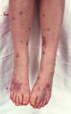 Cutaneous sarcoidosis in a patient with Nijmegen b