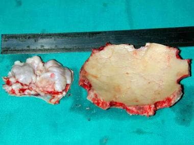 Case 1: Bone flap seen along the removed meningiom