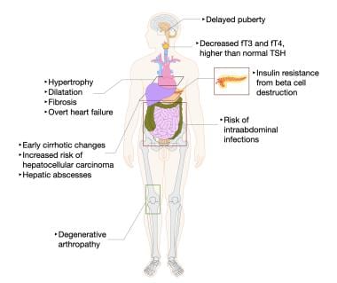 Transfusion Induced Iron Overload Clinical Presentation History