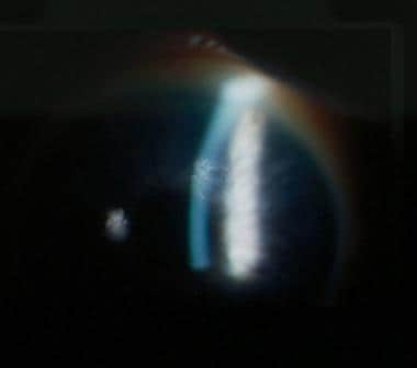 Corneal dots. Cluster of corneal dots. 