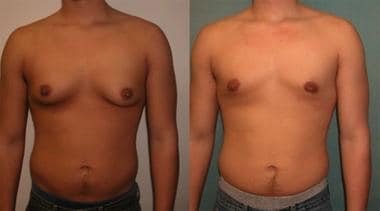 Are Male Breast Lumps Behind The Nipple A Sign Of Gynecomastia?