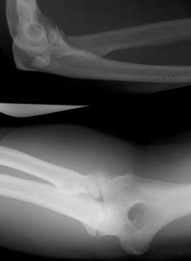 Displaced radial head fracture. 