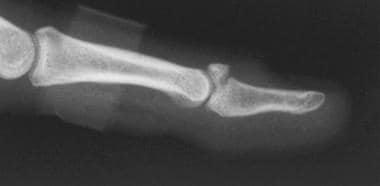 Stable mallet fracture that involves 40% of the jo