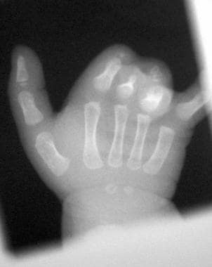 Right hand of 1.5-year-old patient with constricti