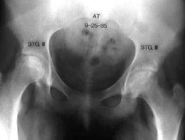 Osteonecrosis, hip. Anteroposterior radiograph sho