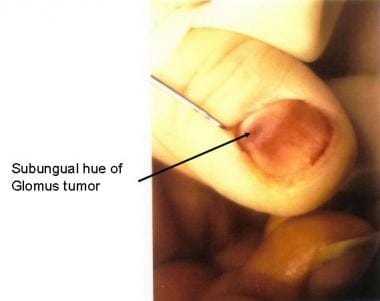 the treatment of glomus finger