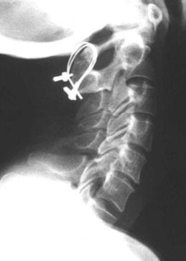 Lateral radiograph of a dystopic displaced os odon