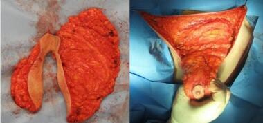 Left: The surgical piece is removed from the left 