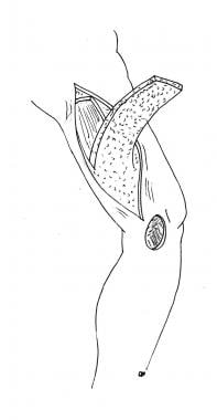 This is an illustration of the adipofascial flap. 