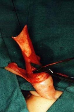 Buttonhole incision along the midline of the subcu