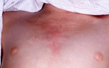 An erythematous "V-neck" rash is present on the up