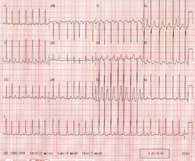 Ventricular rate varies from 130-168 beats per min