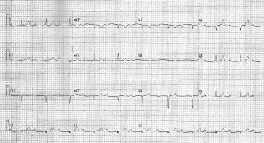 Pacemaker Syndrome. Pronounced PR interval prolong
