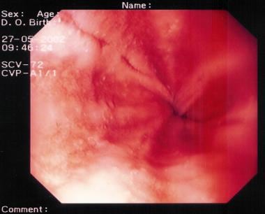 Gastroesophageal Reflux Disease. This image demons