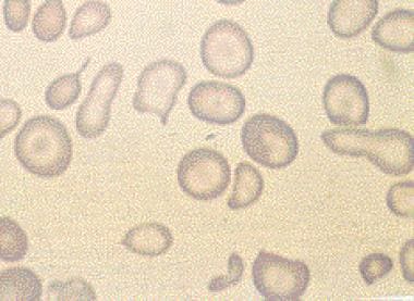 Microcytic anemia. 