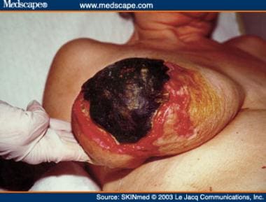 A patient with warfarin-induced skin necrosis. 