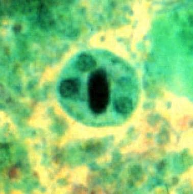 Trichrome stain of Entamoeba histolytica cyst in a