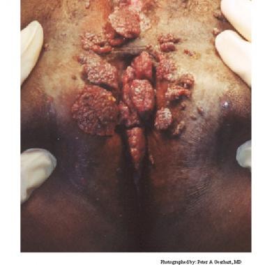 Human papillomavirus (HPV). These condylomata exte