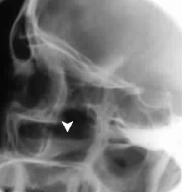Air-fluid level (arrow) in the maxillary sinus sug
