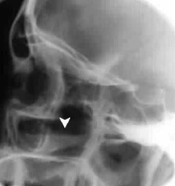 maxillary and ethmoid sinus disease