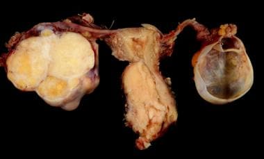 Cervical carcinoma with adnexa. 