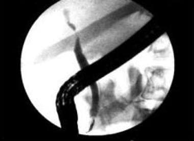 Tight stricture of a common hepatic duct in a pati