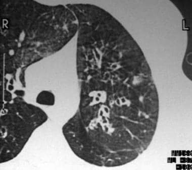 Cylindrical bronchiectasis with signet-ring appear