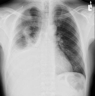 Pleural Effusion Treatment Management Approach Considerations Therapeutic Thoracentesis Tube Thoracostomy