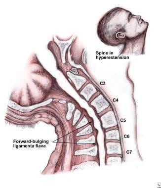 C3, C4, & C5 Vertebrae Spinal Cord Injury