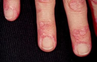 Gottron papules and nailfold telangiectasia are pr