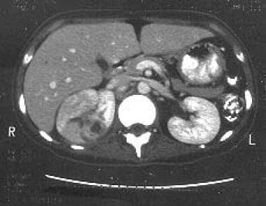 Contrasted CT scan that demonstrates a corticomedu
