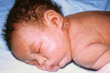 Staphylococcal scalded skin syndrome. Photograph b