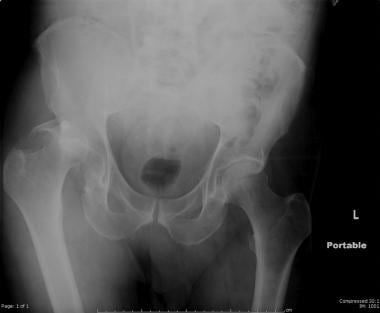 Fracture-dislocation of the right hip. The bony fr